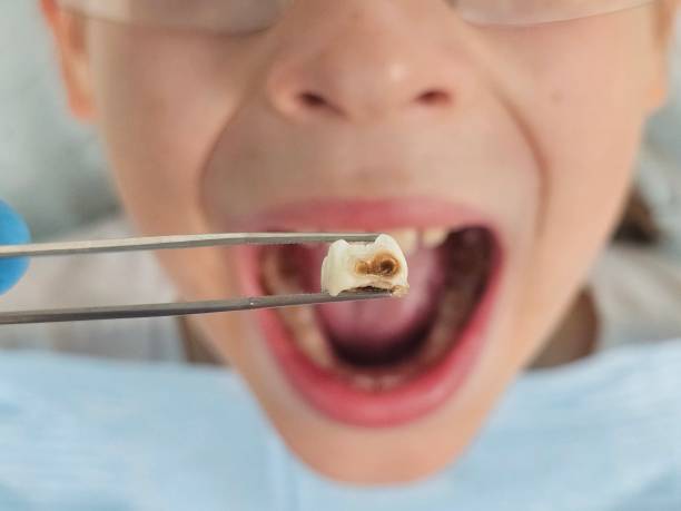 Best Emergency Dental Extractions in Doffing, TX